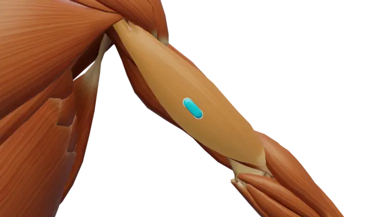 SENIAM-Elektrodenposition am M. Biceps brachii (3D-Muskeldarstellung)