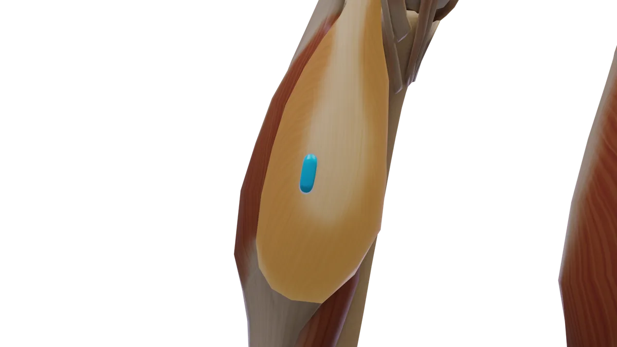 SENIAM-Elektrodenposition am M. Gastrocnemius medialis (3D-Muskeldarstellung)