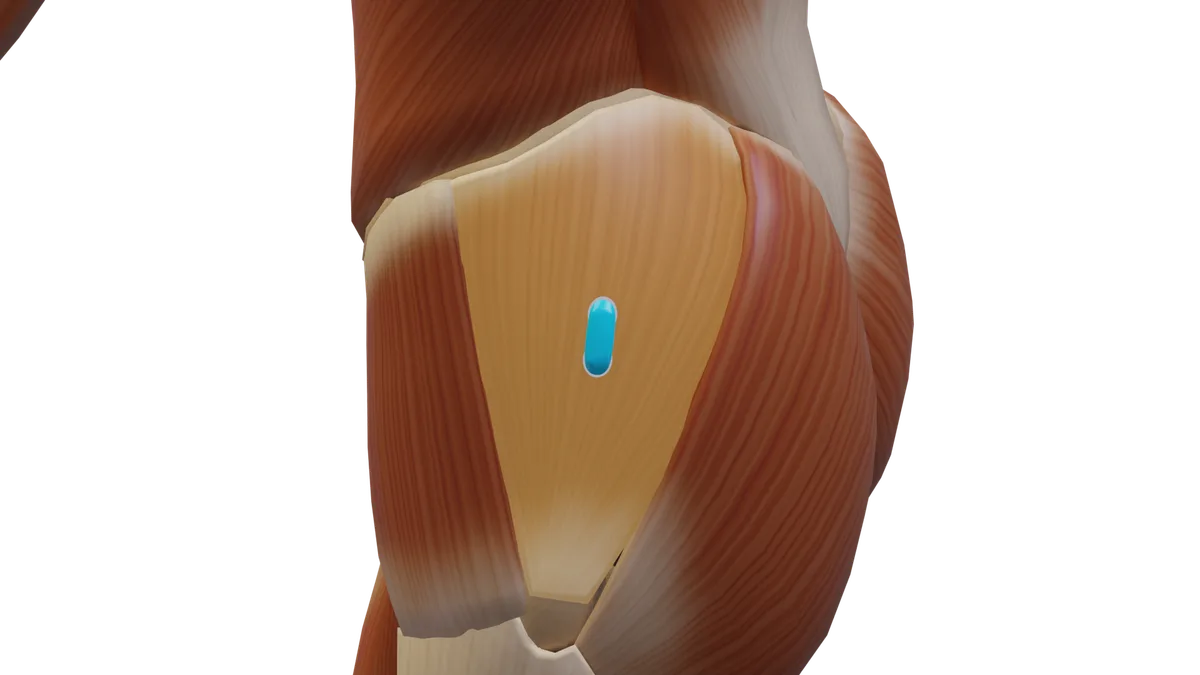 SENIAM-Elektrodenposition am M. Gluteus medius (3D-Muskeldarstellung)
