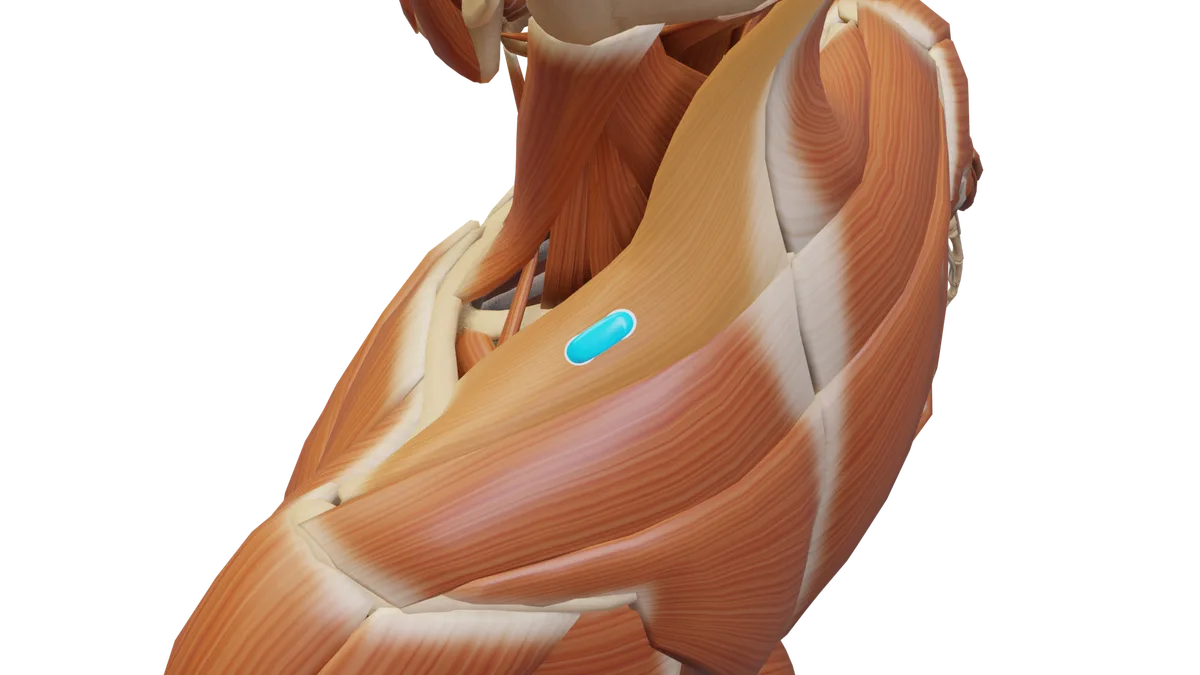 SENIAM-Elektrodenposition am M. Trapezius pars descendens (3D-Muskeldarstellung)